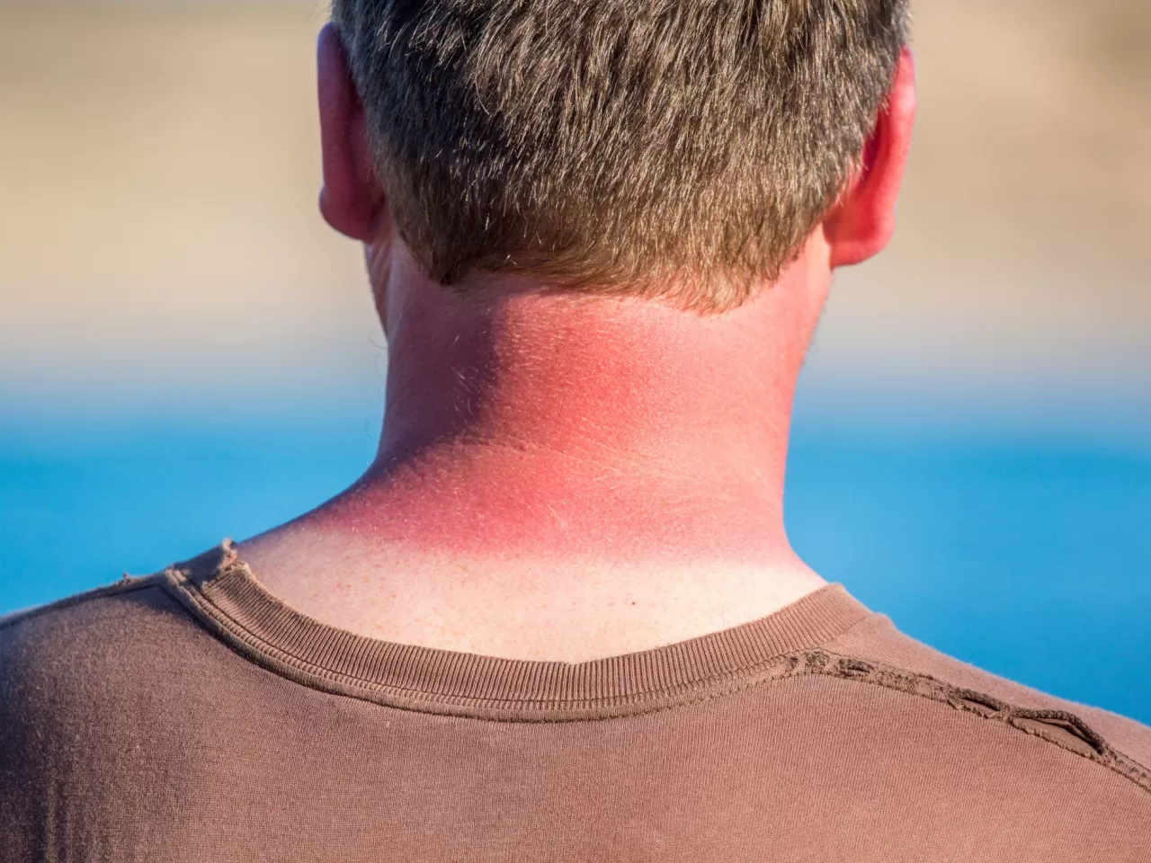 Güneş Yanığı Acısı