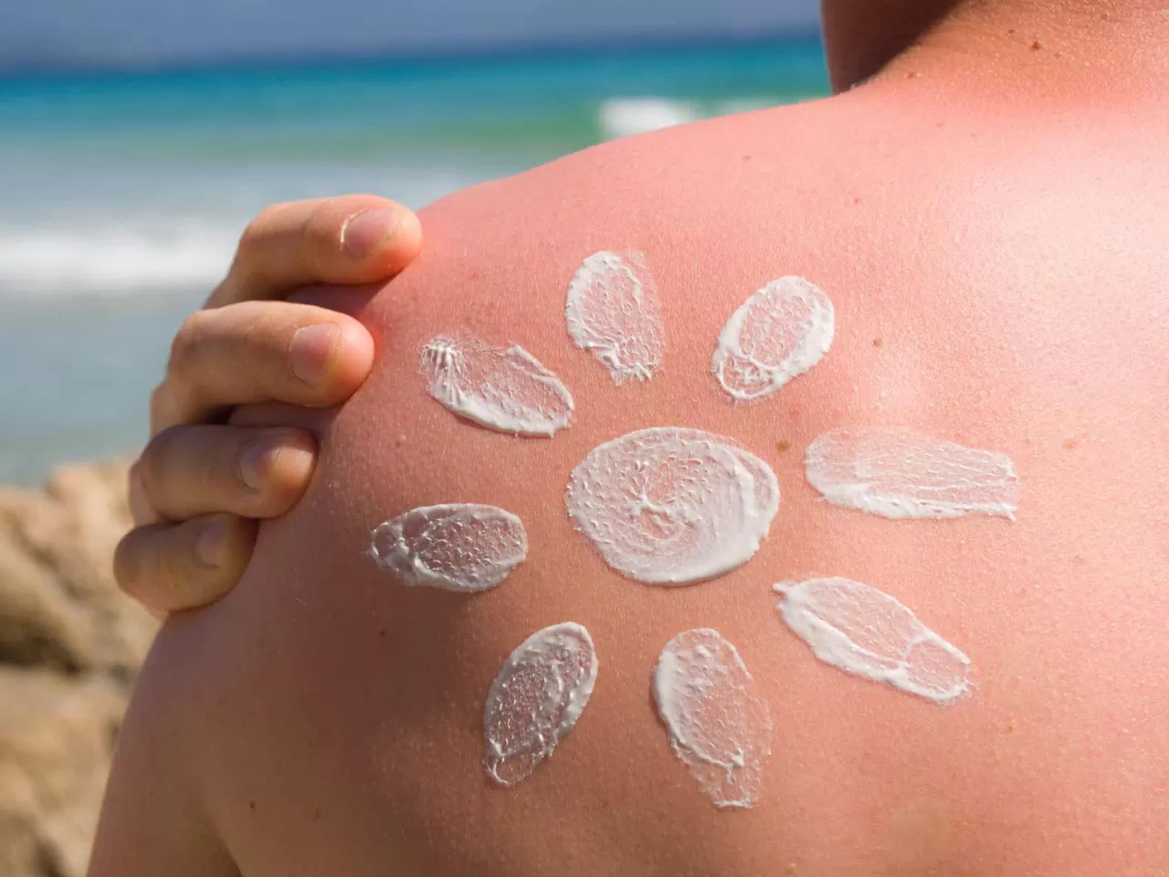 Güneş Yanığı İçin İyi Gelecek Tavsiyeler